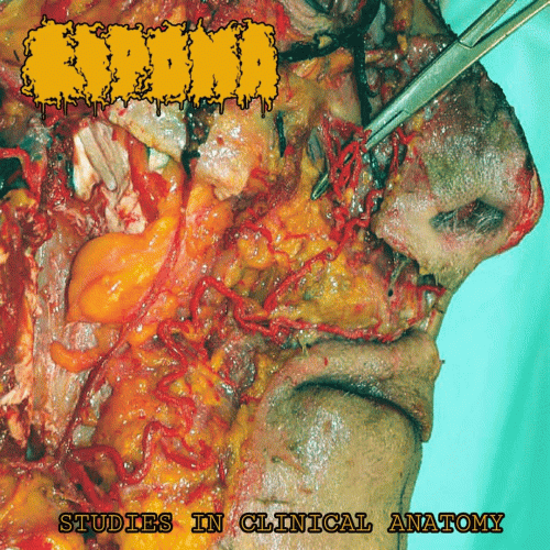 Lipoma : Studies in Clinical Anatomy